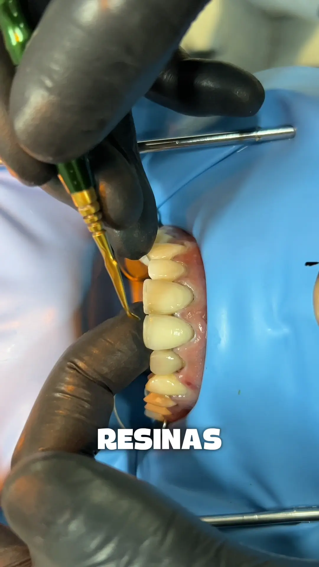 Resinas Compostas Estratificadas
